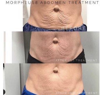 Morpheus8 body abdomen skin tightening before and after results