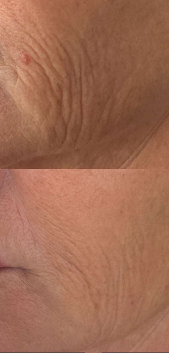 Morpheus8 face skin texture before and after results